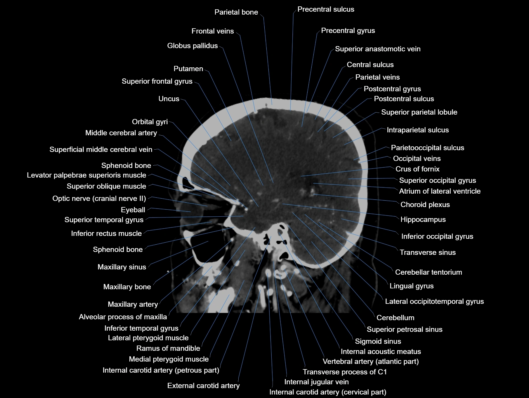 CT scan brain sagittal cross sectional anatomy image-img-00001-00026.webp